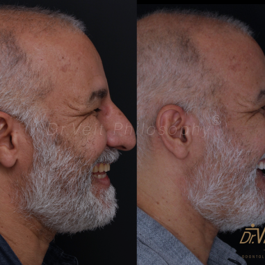 https_drveit.com.br_casos-clinicos_reabilitacao-oral-com-lentes-de-contato-4__4