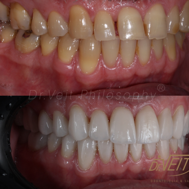 https_drveit.com.br_casos-clinicos_reabilitacao-oral-com-lentes-de-contato-4__5