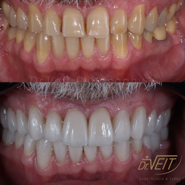 https_drveit.com.br_casos-clinicos_reabilitacao-oral-com-lentes-de-contato-4__9