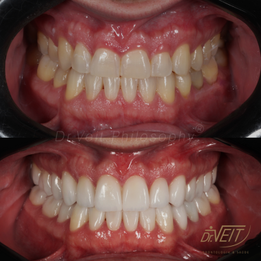 https_drveit.com.br_casos-clinicos_reabilitacao-oral-com-lentes-de-contato-5__10