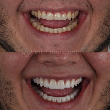 https_drveit.com.br_casos-clinicos_reabilitacao-oral-com-lentes-de-contato-5__11