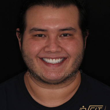 https_drveit.com.br_casos-clinicos_reabilitacao-oral-com-lentes-de-contato-5__12