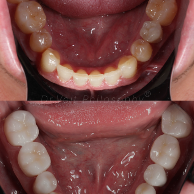 https_drveit.com.br_casos-clinicos_reabilitacao-oral-com-lentes-de-contato-5__13