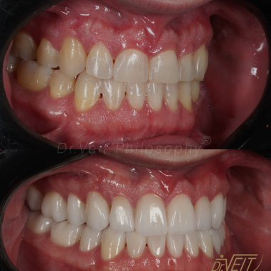 https_drveit.com.br_casos-clinicos_reabilitacao-oral-com-lentes-de-contato-5__14