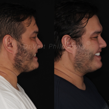 https_drveit.com.br_casos-clinicos_reabilitacao-oral-com-lentes-de-contato-5__2