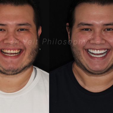 https_drveit.com.br_casos-clinicos_reabilitacao-oral-com-lentes-de-contato-5__6