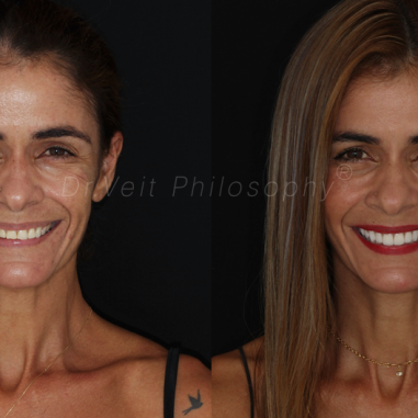 https_drveit.com.br_casos-clinicos_reabilitacao-oral-com-lentes-de-contato-6__1