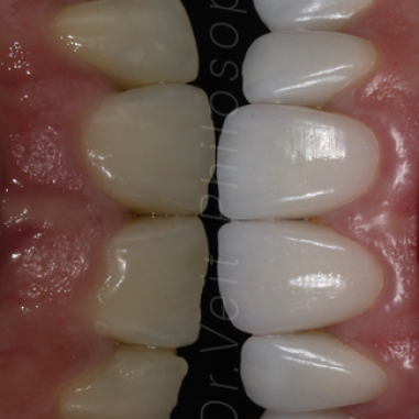 https_drveit.com.br_casos-clinicos_reabilitacao-oral-com-lentes-de-contato-6__12