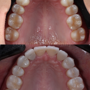 https_drveit.com.br_casos-clinicos_reabilitacao-oral-com-lentes-de-contato-7__10