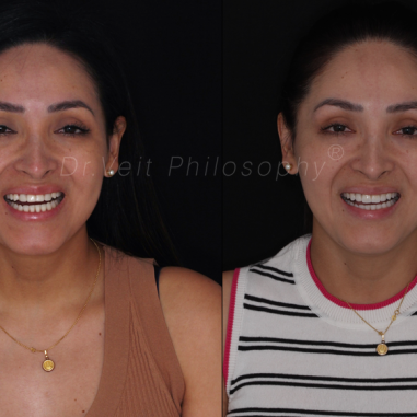 https_drveit.com.br_casos-clinicos_reabilitacao-oral-com-lentes-de-contato-7__11