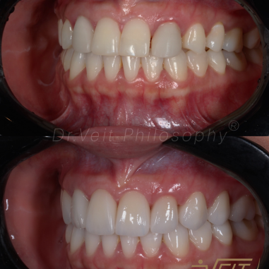 https_drveit.com.br_casos-clinicos_reabilitacao-oral-com-lentes-de-contato-7__12