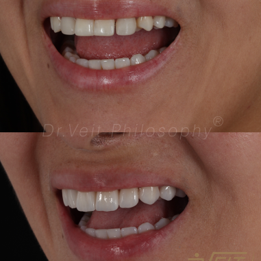 https_drveit.com.br_casos-clinicos_reabilitacao-oral-com-lentes-de-contato-7__2