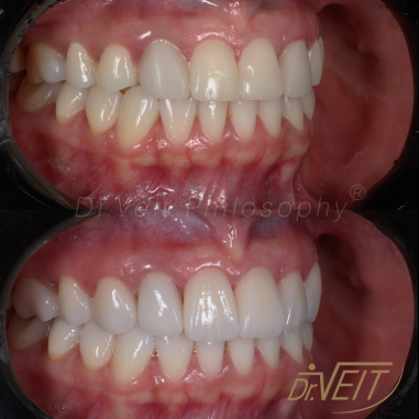 https_drveit.com.br_casos-clinicos_reabilitacao-oral-com-lentes-de-contato-7__3