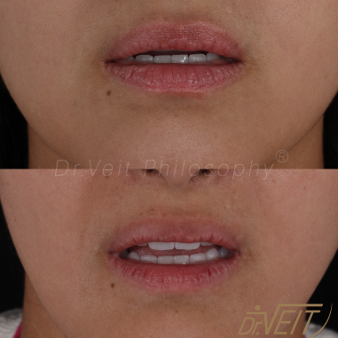 https_drveit.com.br_casos-clinicos_reabilitacao-oral-com-lentes-de-contato-7__9