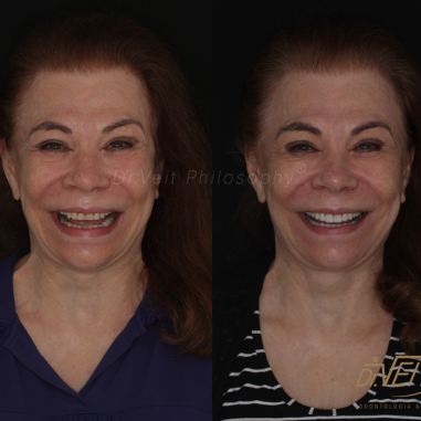 https_drveit.com.br_casos-clinicos_reabilitacao-oral-com-lentes-de-contato-8__1