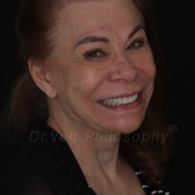 https_drveit.com.br_casos-clinicos_reabilitacao-oral-com-lentes-de-contato-8__2