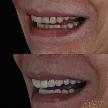 https_drveit.com.br_casos-clinicos_reabilitacao-oral-com-lentes-de-contato-8__4