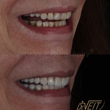 https_drveit.com.br_casos-clinicos_reabilitacao-oral-com-lentes-de-contato-8__5