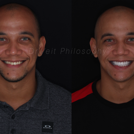 https_drveit.com.br_casos-clinicos_reabilitacao-oral-com-lentes-de-contato-9__1