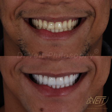 https_drveit.com.br_casos-clinicos_reabilitacao-oral-com-lentes-de-contato-9__10