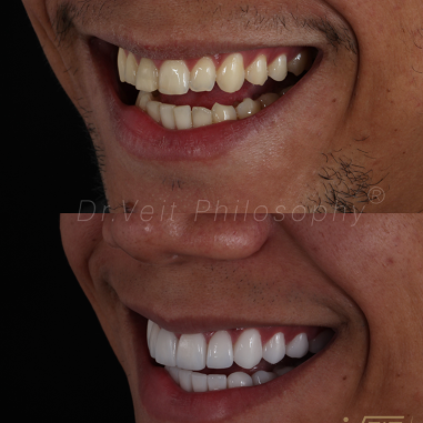 https_drveit.com.br_casos-clinicos_reabilitacao-oral-com-lentes-de-contato-9__11