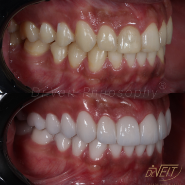 https_drveit.com.br_casos-clinicos_reabilitacao-oral-com-lentes-de-contato-9__12