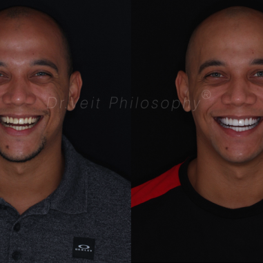 Reabilitação Oral com Lentes de Contato