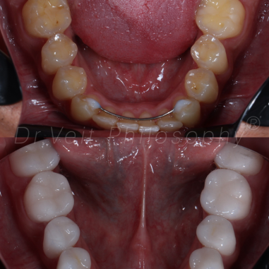 https_drveit.com.br_casos-clinicos_reabilitacao-oral-com-lentes-de-contato-9__14