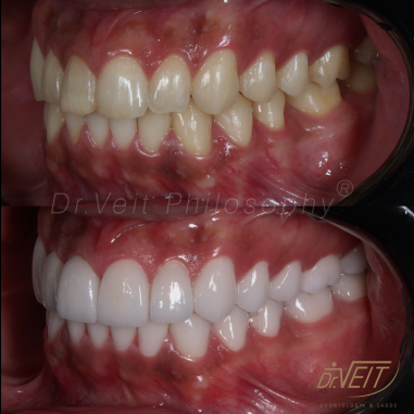 https_drveit.com.br_casos-clinicos_reabilitacao-oral-com-lentes-de-contato-9__15