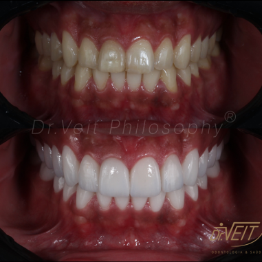 https_drveit.com.br_casos-clinicos_reabilitacao-oral-com-lentes-de-contato-9__4