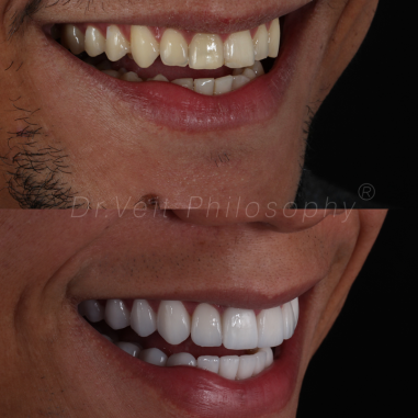 https_drveit.com.br_casos-clinicos_reabilitacao-oral-com-lentes-de-contato-9__6