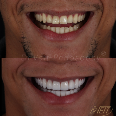 https_drveit.com.br_casos-clinicos_reabilitacao-oral-com-lentes-de-contato-9__8