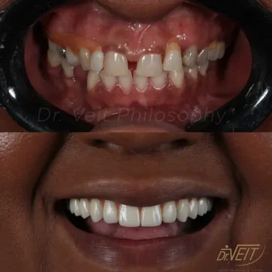 implante-carga-imediata-zirconia-veit2-5