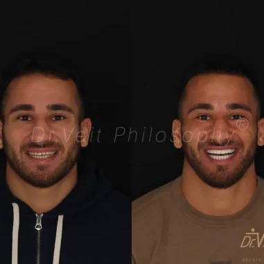 lentes-de-contato-veit-1