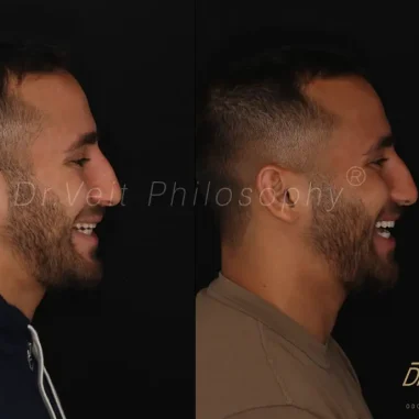 lentes-de-contato-veit-2