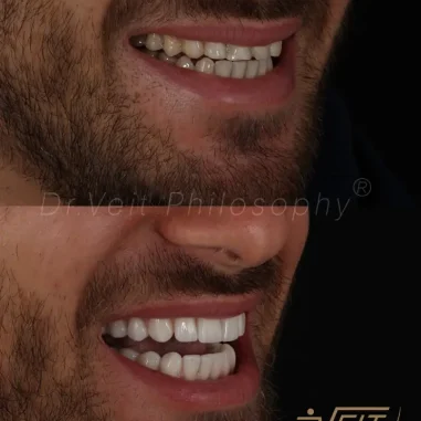 lentes-de-contato-veit-7