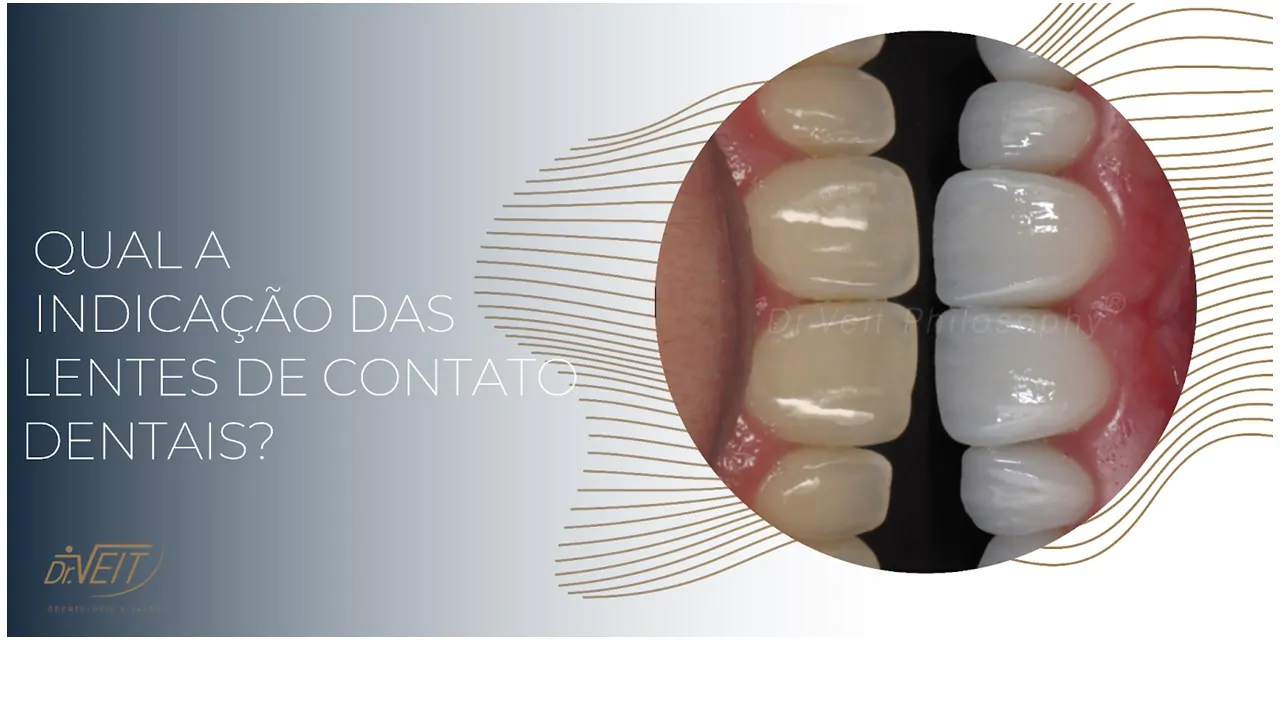 Qual a indicação das Lentes de Contato Dentais