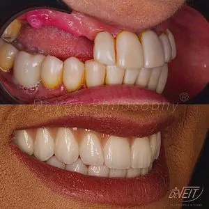 implante dentário