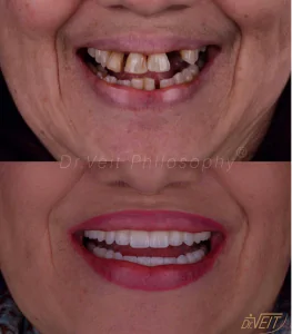 implante dentário