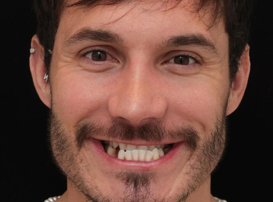 Eliezer antes e depois tratamento dentario