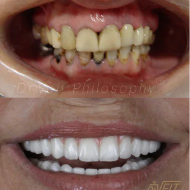 https_drveit.com.br_casos-clinicos_protocolo-de-zirconia-sobre-implantes-com-carga-imediata-11__10