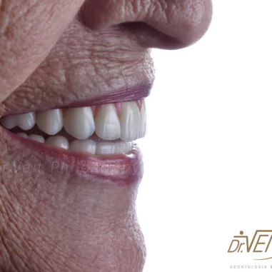 https_drveit.com.br_casos-clinicos_protocolo-de-zirconia-sobre-implantes-com-carga-imediata-5__3