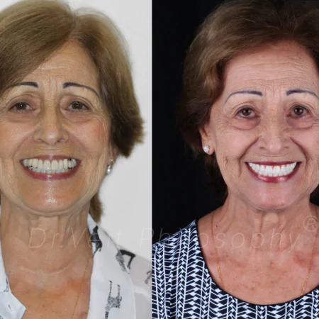 https_drveit.com.br_casos-clinicos_protocolo-de-zirconia-sobre-implantes-com-carga-imediata-5__5