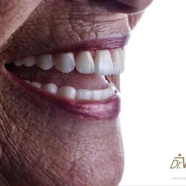 https_drveit.com.br_casos-clinicos_protocolo-de-zirconia-sobre-implantes-com-carga-imediata-5__9