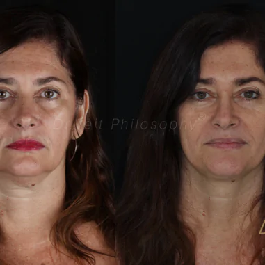 https_drveit.com.br_casos-clinicos_reabilitacao-oral-com-implantes-de-carga-imediata-3__2