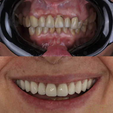 https_drveit.com.br_casos-clinicos_reabilitacao-oral-com-implantes-de-carga-imediata-3__3