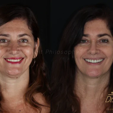 https_drveit.com.br_casos-clinicos_reabilitacao-oral-com-implantes-de-carga-imediata-3__4