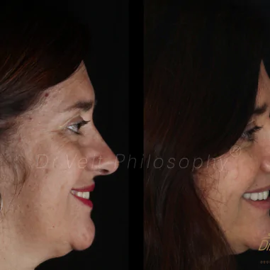 https_drveit.com.br_casos-clinicos_reabilitacao-oral-com-implantes-de-carga-imediata-3__6