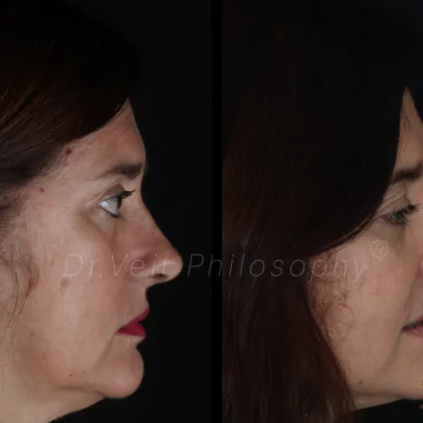 https_drveit.com.br_casos-clinicos_reabilitacao-oral-com-implantes-de-carga-imediata-3__7