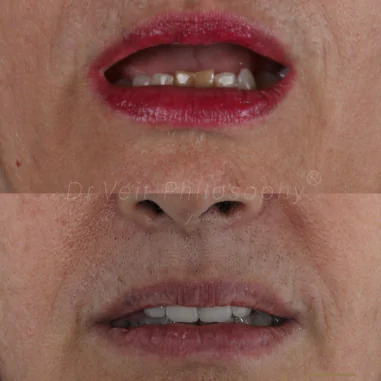 https_drveit.com.br_casos-clinicos_reabilitacao-oral-com-implantes-de-carga-imediata-3__9